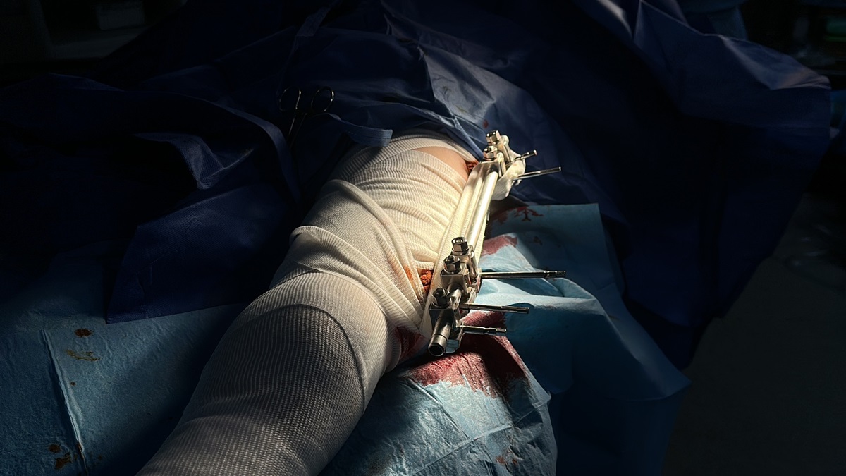 The WHO analysis highlights the huge unmet needs for rehabilitation in Gaza The WHO analysis highlights the huge unmet needs for rehabilitation in Gaza