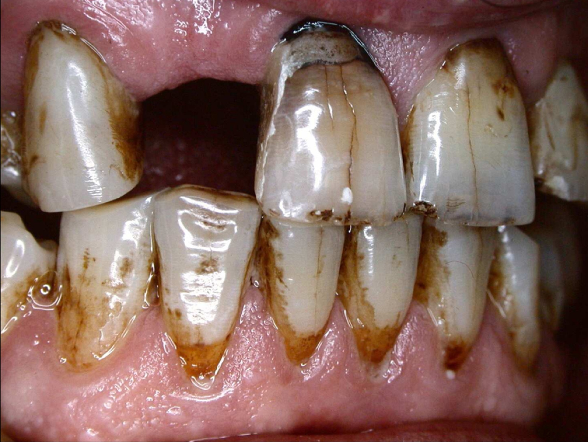 Cigar smoking damages your teeth and gums