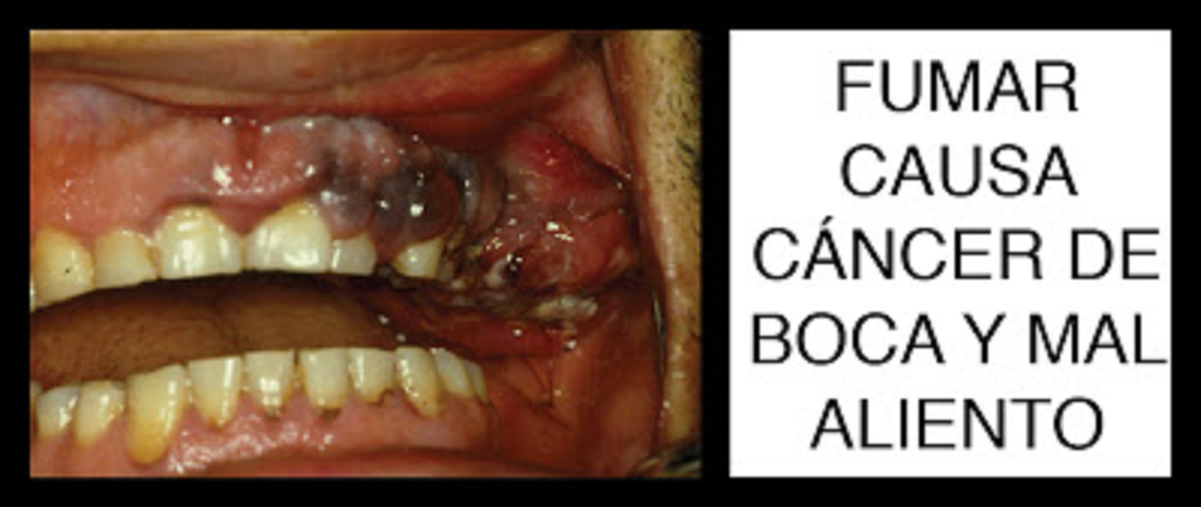 Smoking causes oral cancer and bad breath