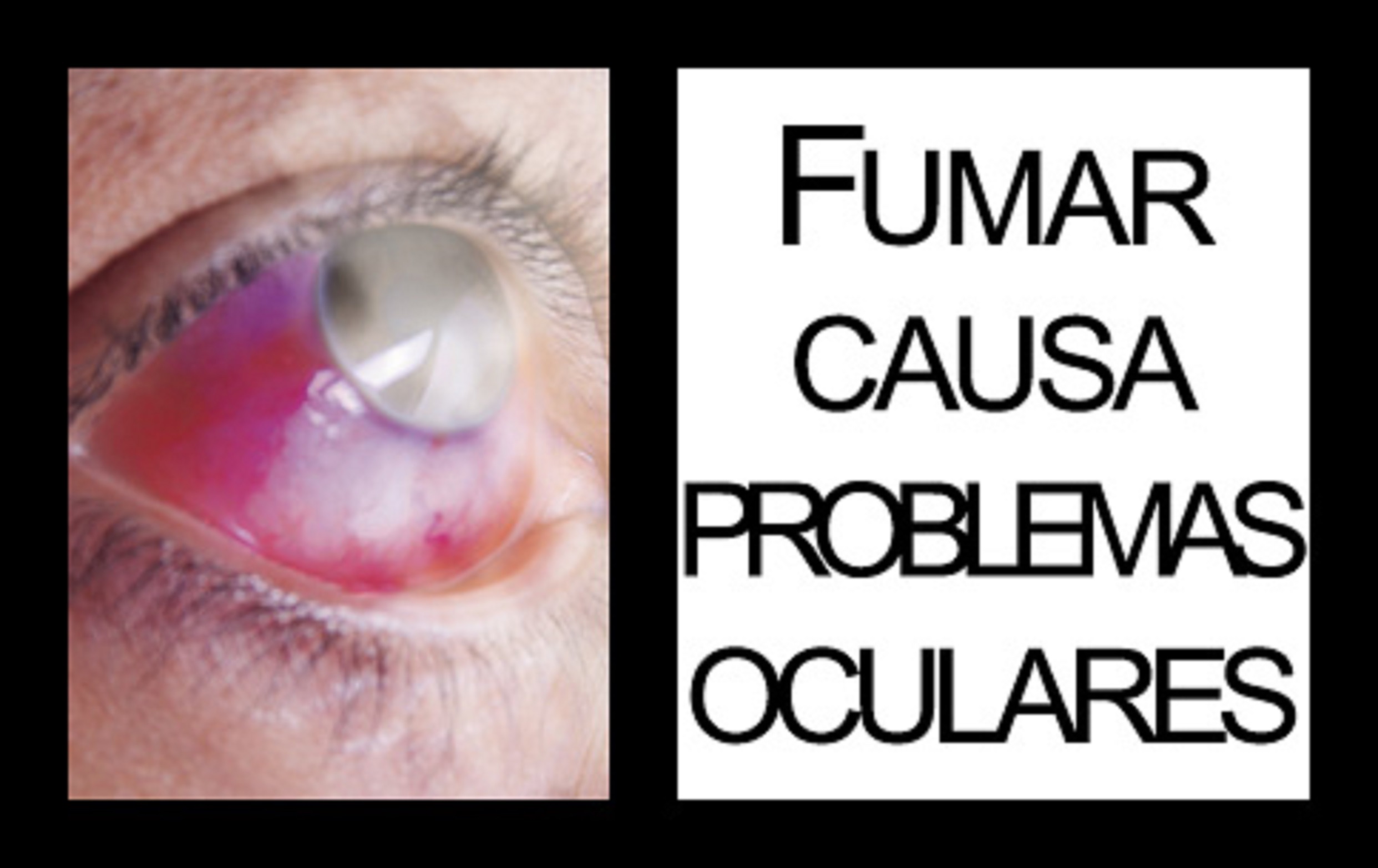 Smoking causes vision impairment