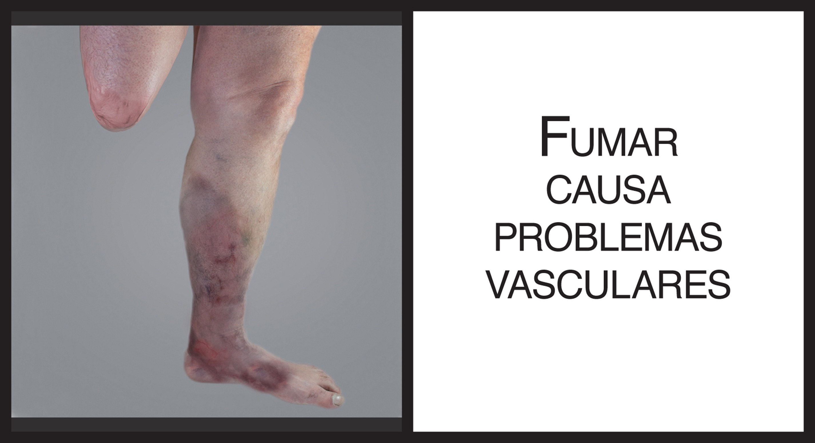 Smoking causes vascular problems
