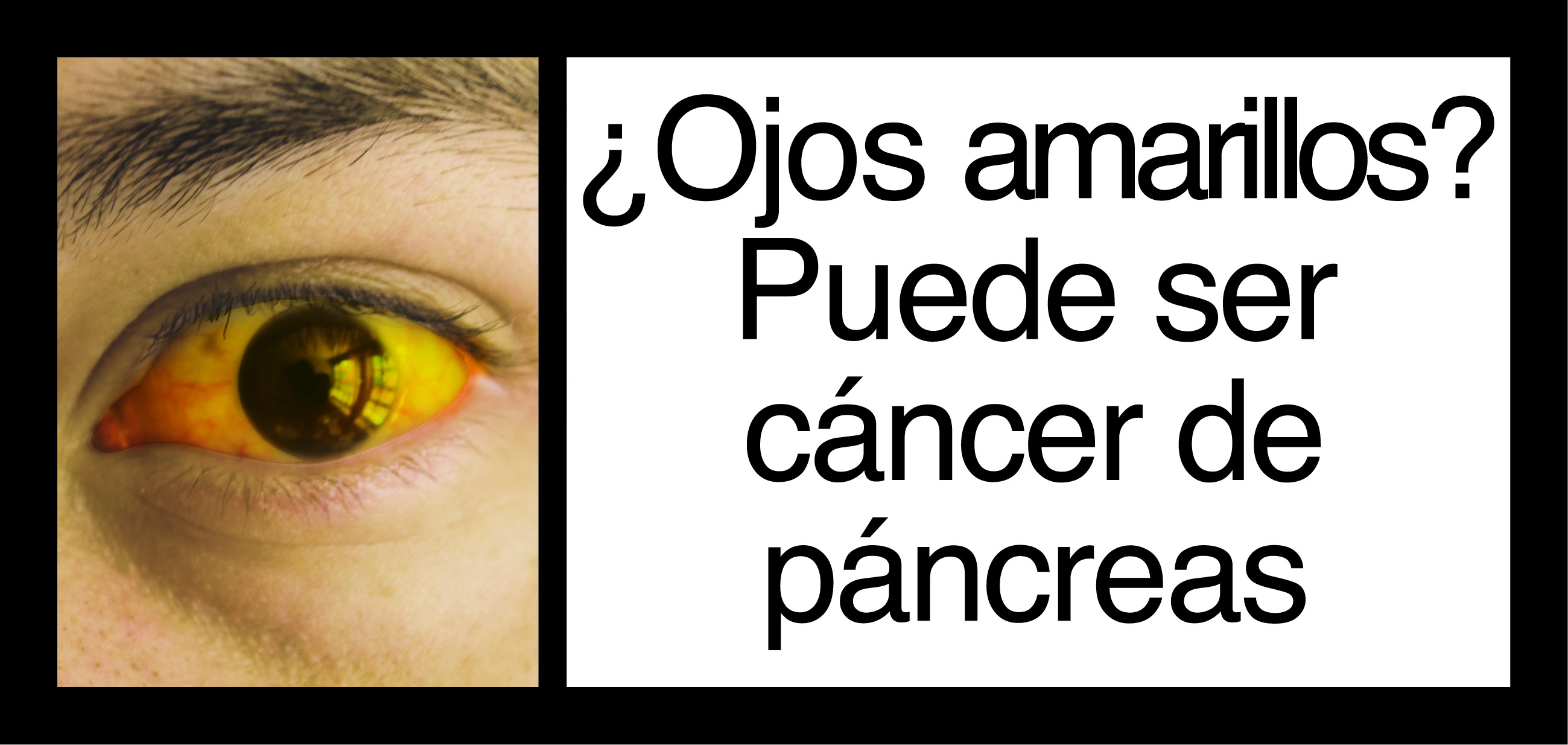 Yellow eyes? It can be pancreatic cancer