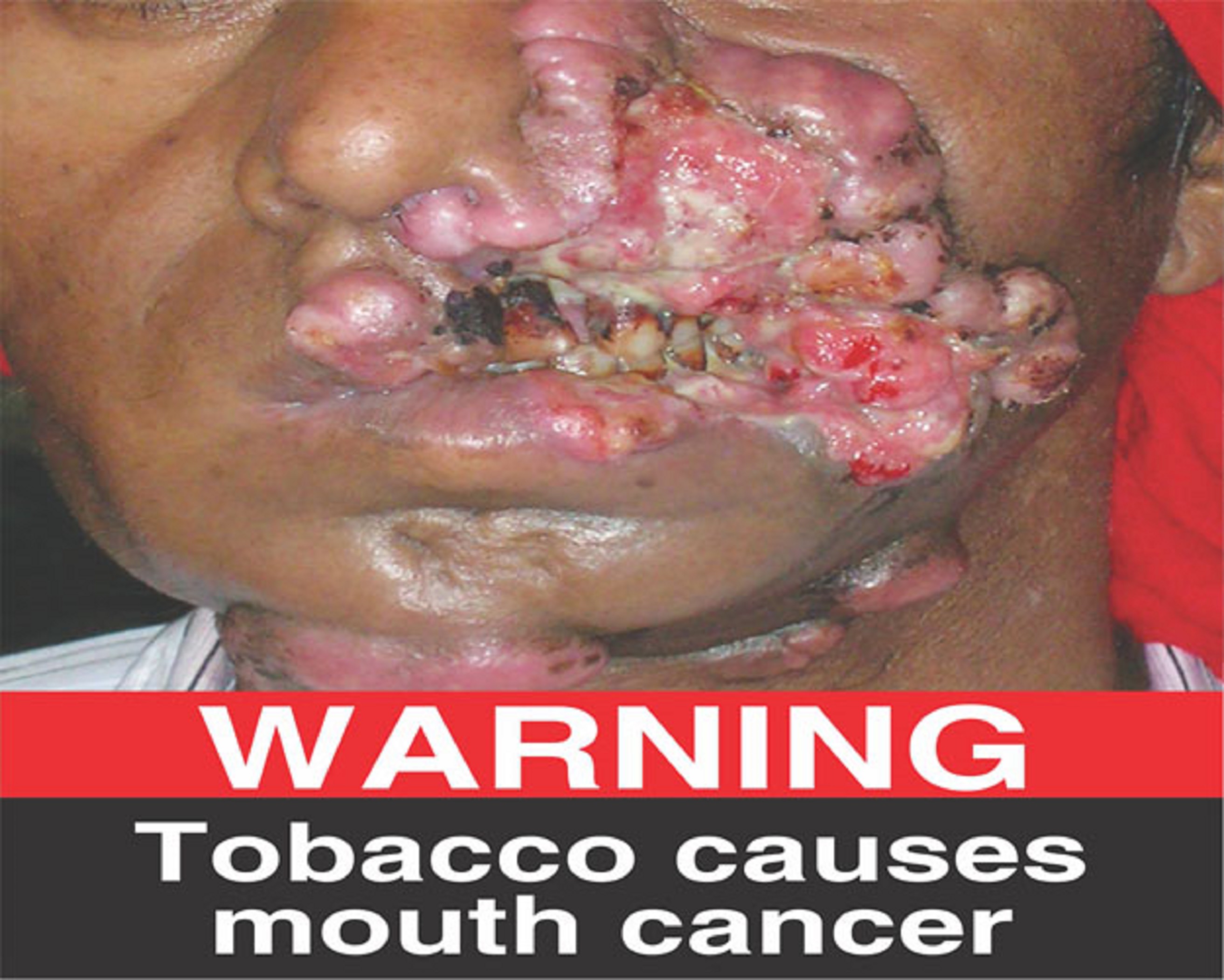 Warning - Tobacco causes mouth cancer - image 1