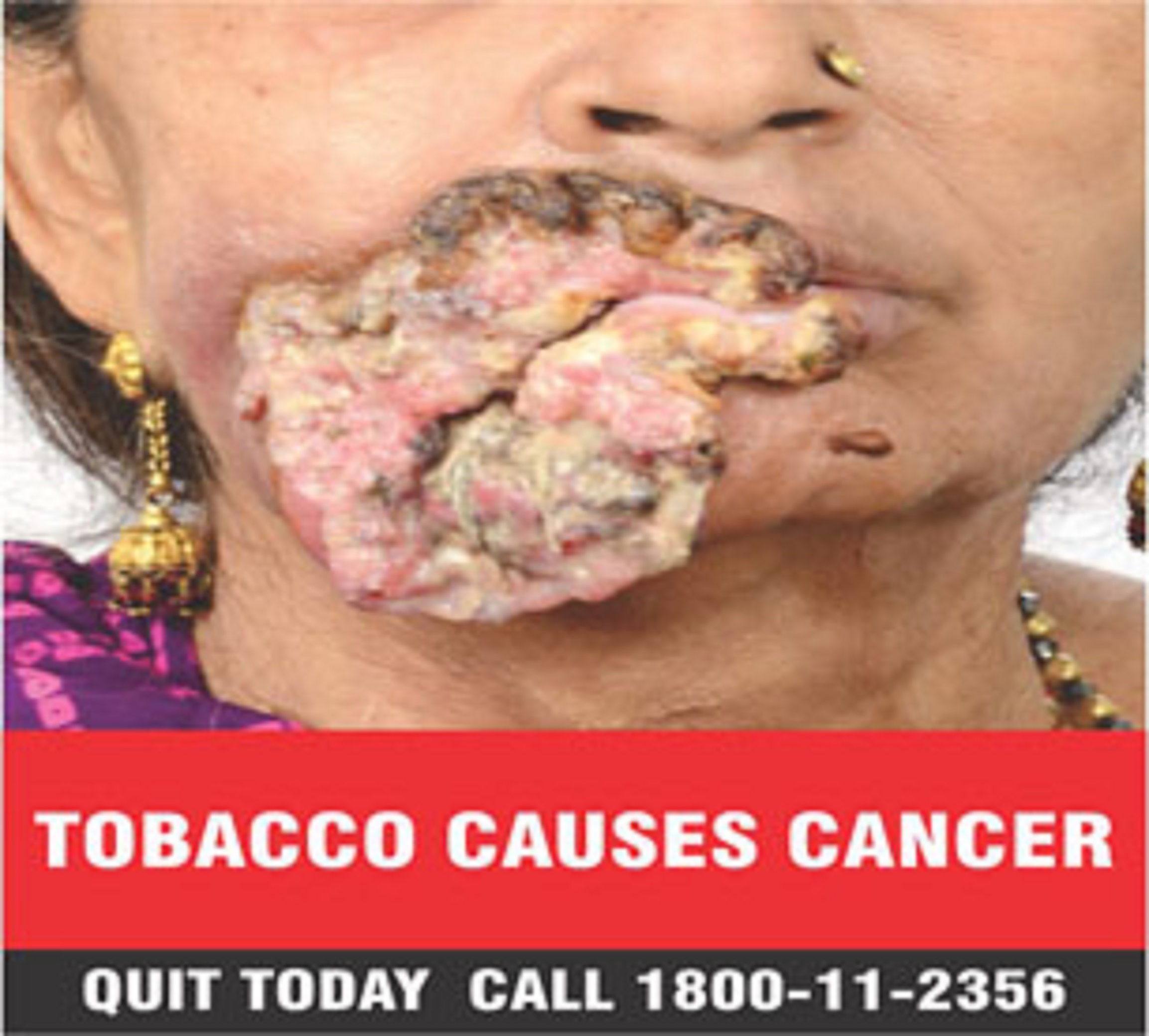 Tobacco causes cancer