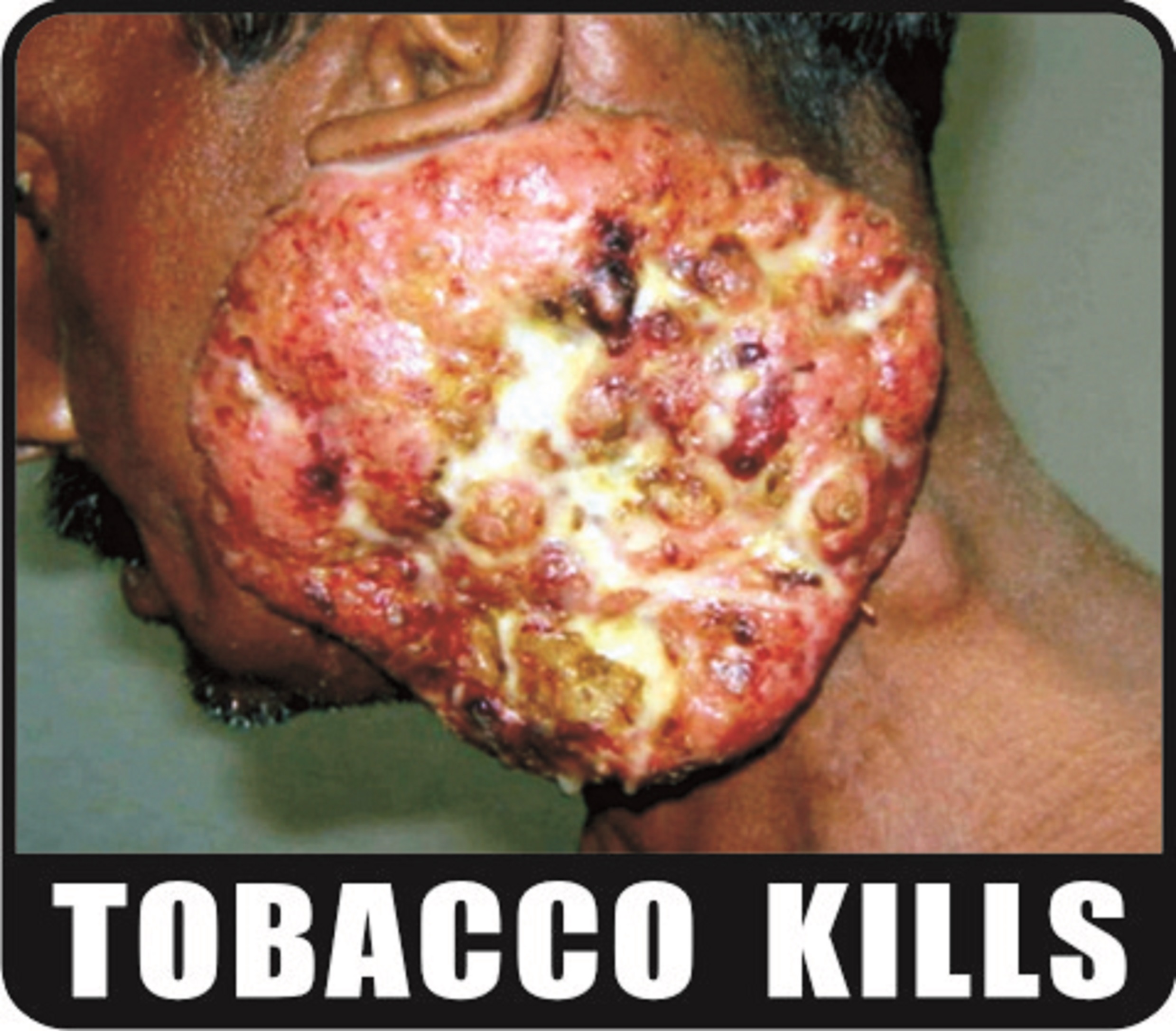 Tobacco kills - image 3
