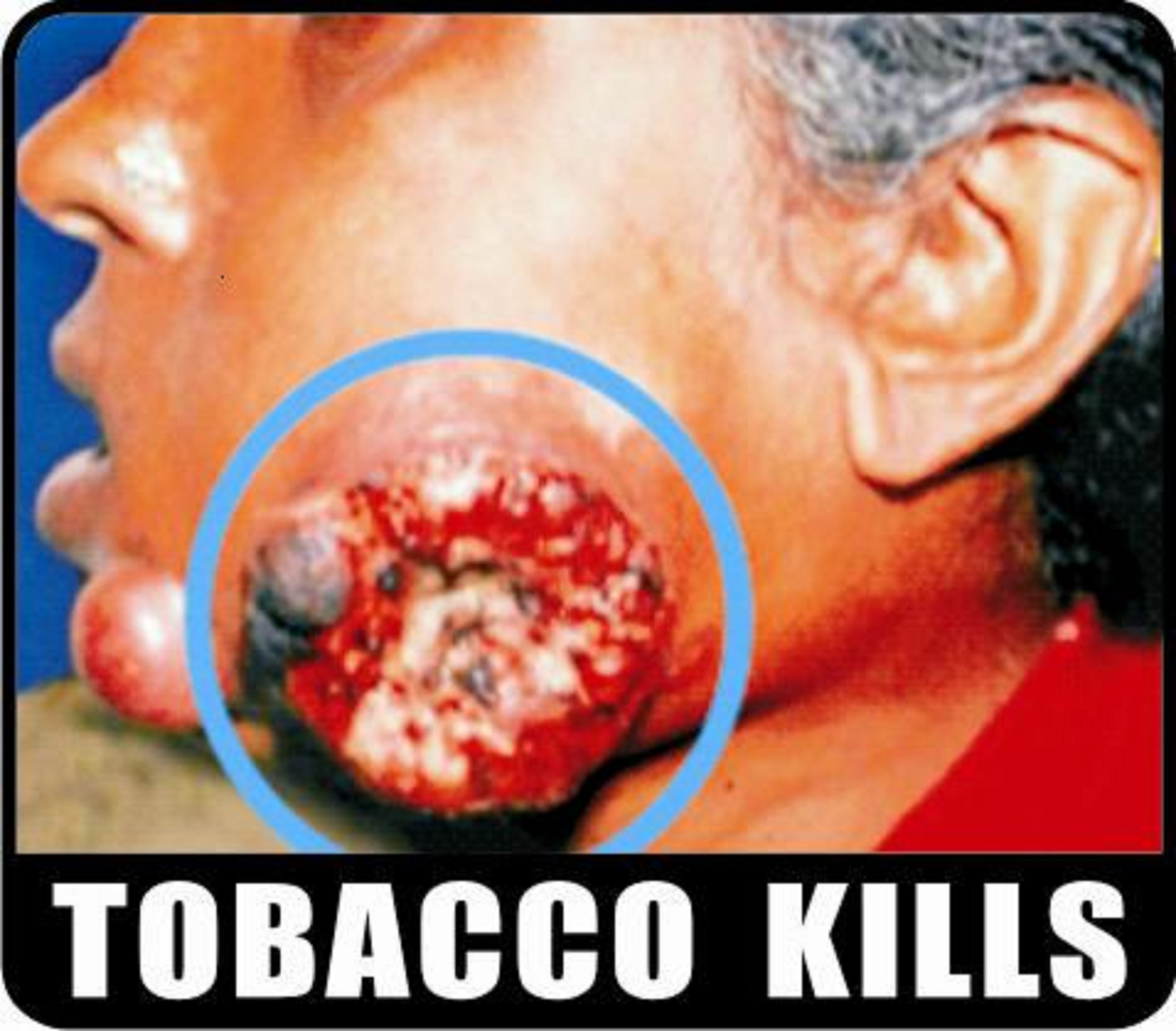 Tobacco kills - image 4