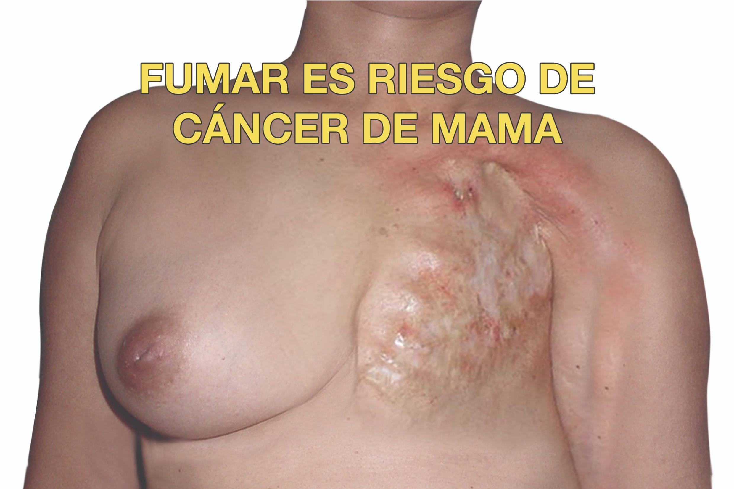 Smoking causes breast cancer