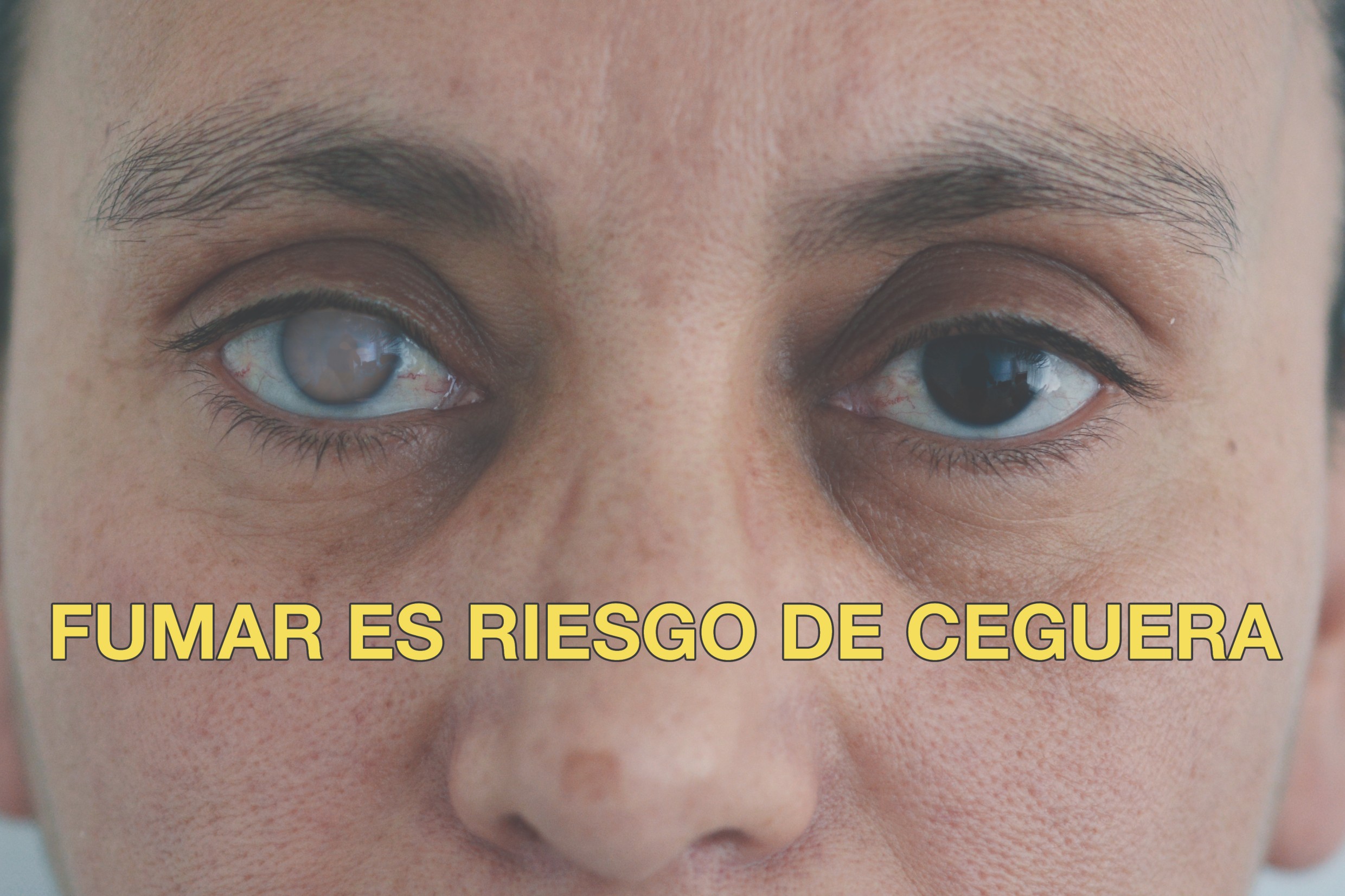 Smoking puts you at risk of blindness