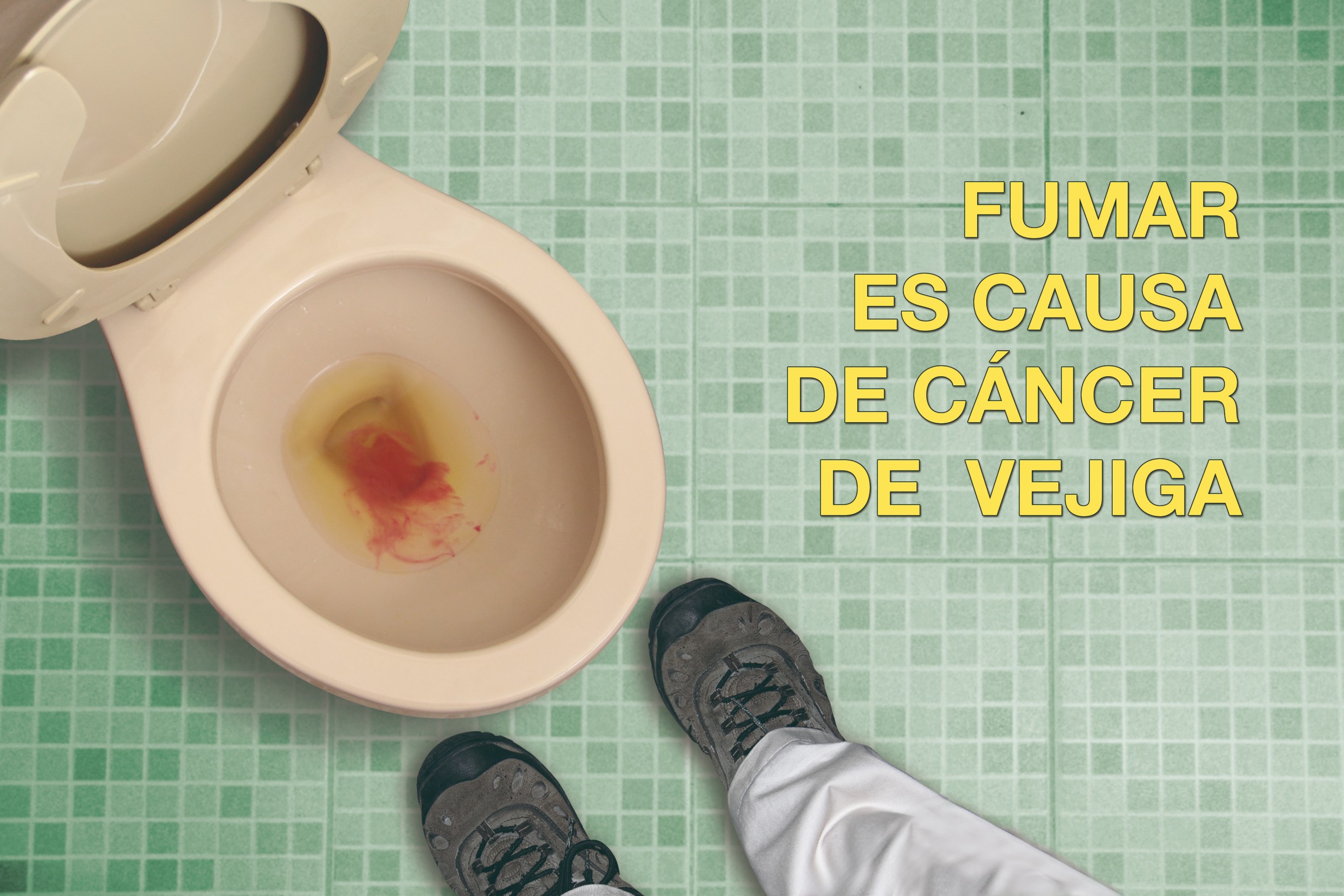 Smoking causes bladder cancer
