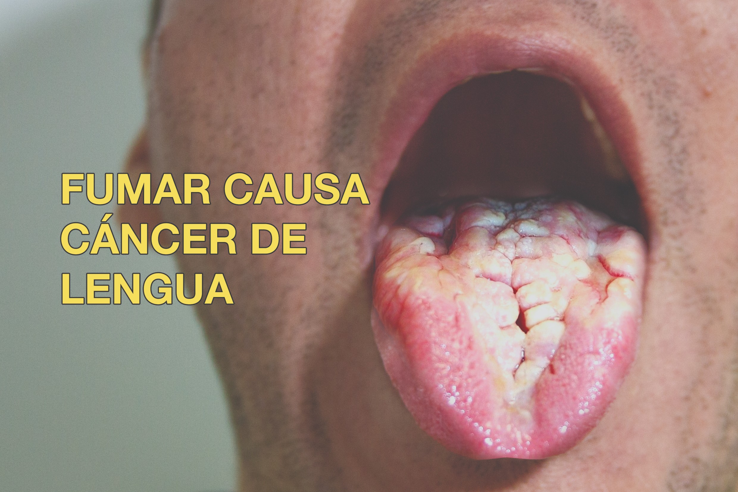 Smoking causes tongue cancer