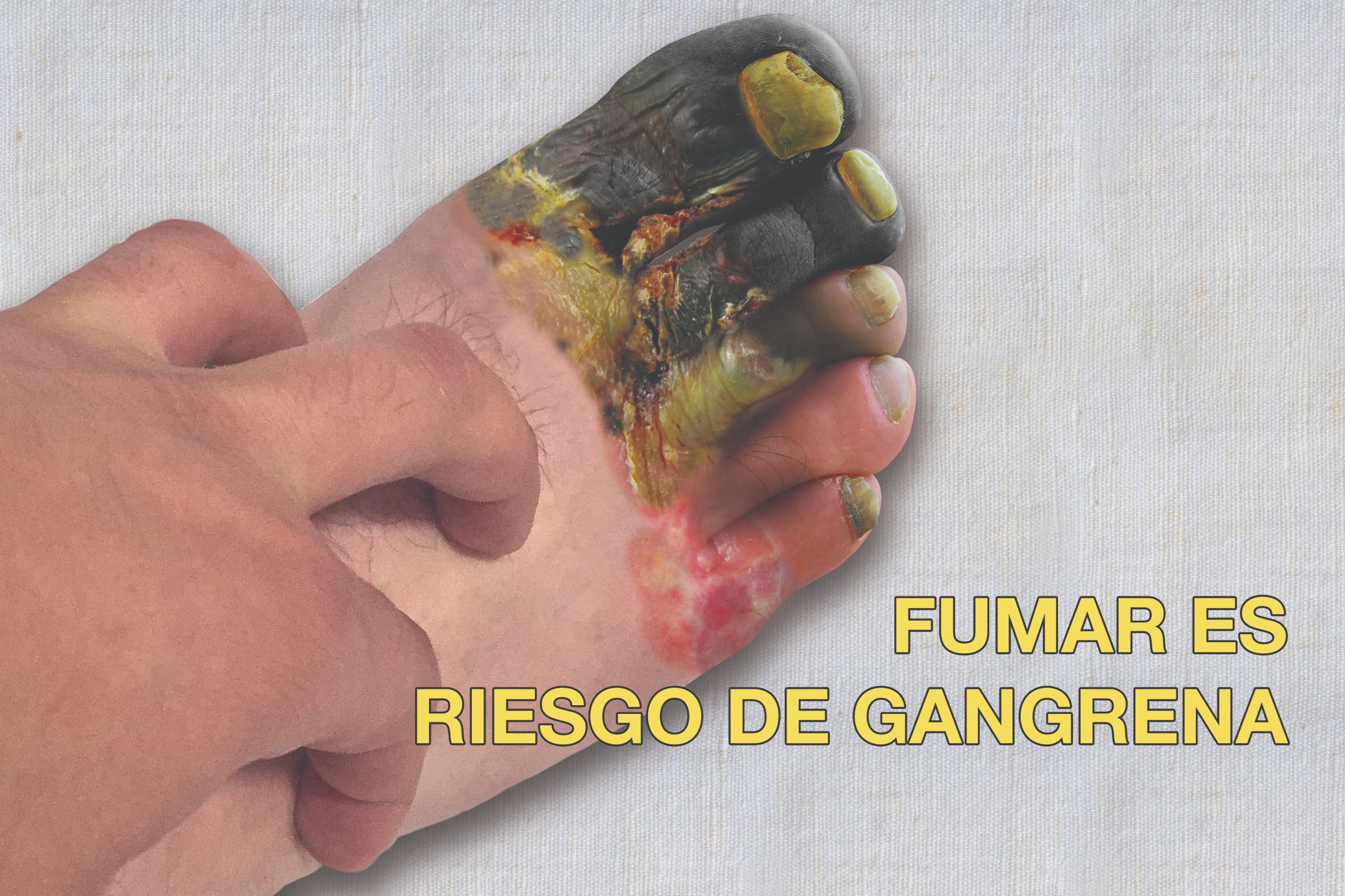 Smoking puts you at risk of gangrene