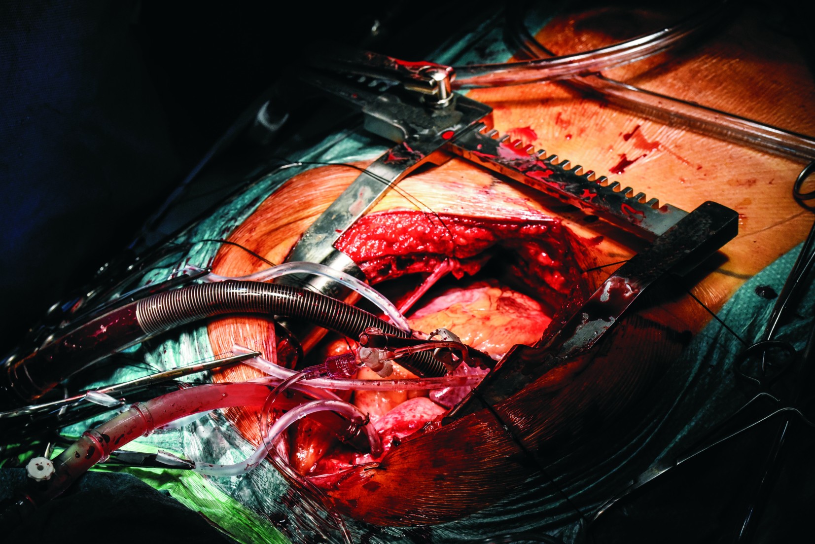 Smoking causes heart attacks - New Zealand - image 1