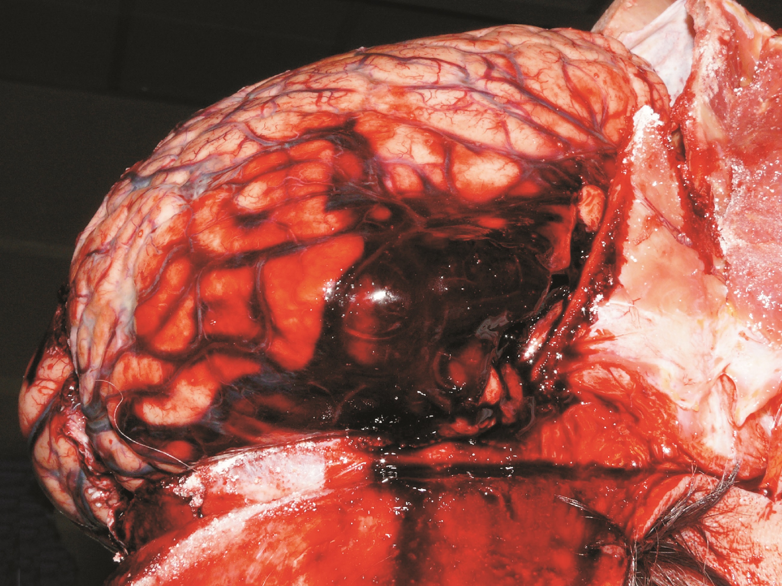 Smoking is a major cause of stroke - New Zealand - image 2