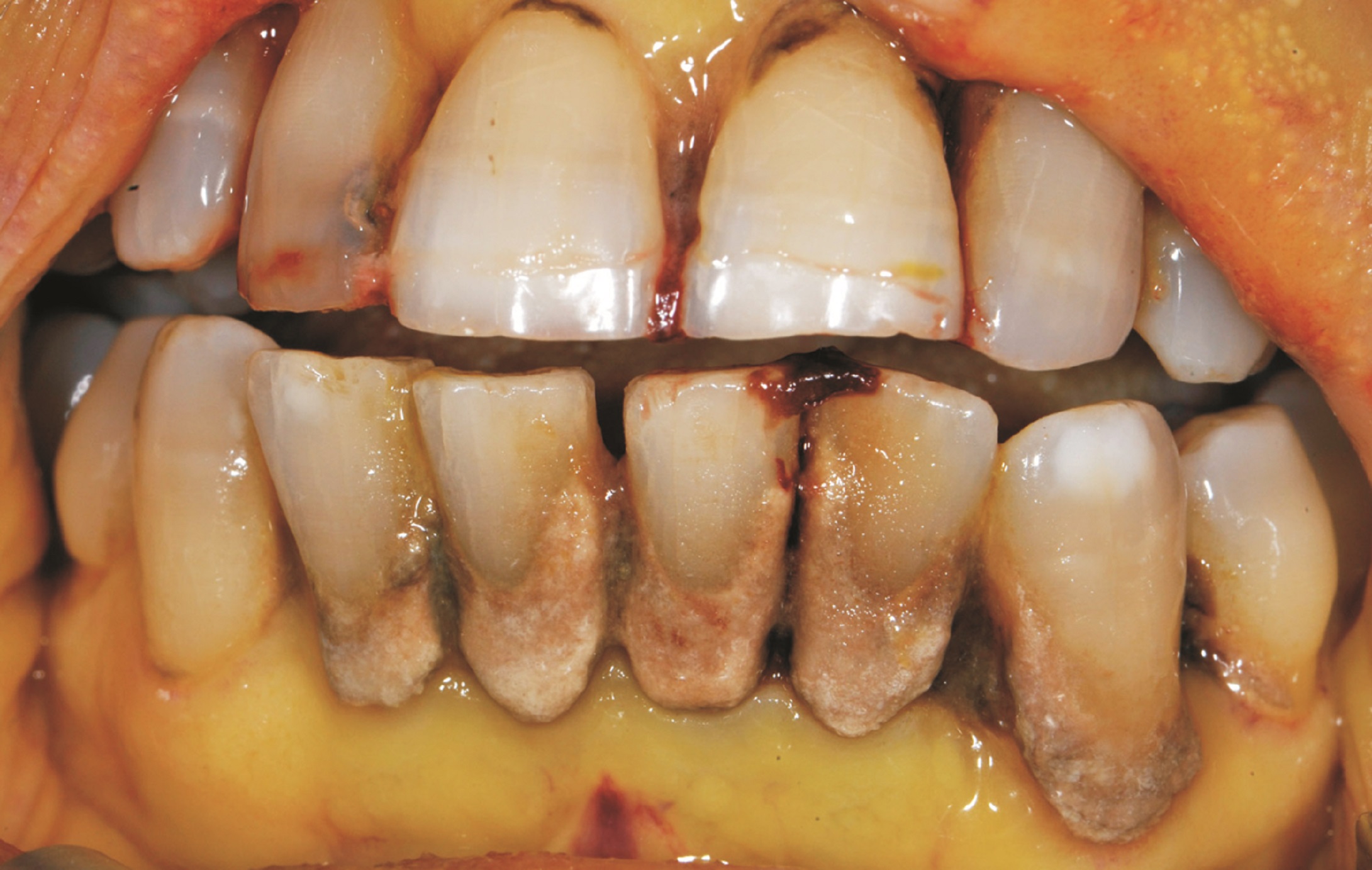 Smoking causes gum disease and stinking breath - New Zealand