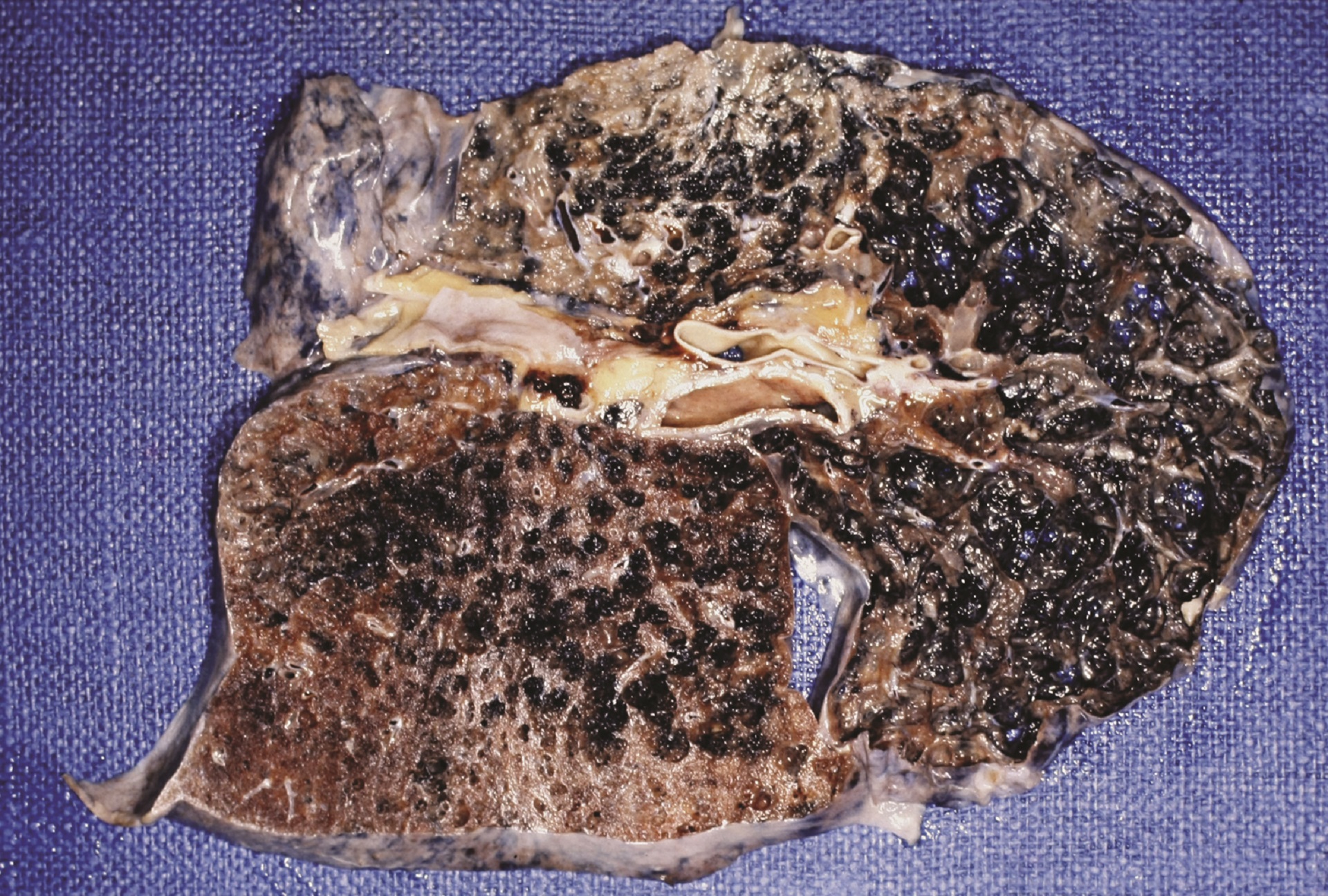 Smoking causes over 80% of lung cancers - New Zealand