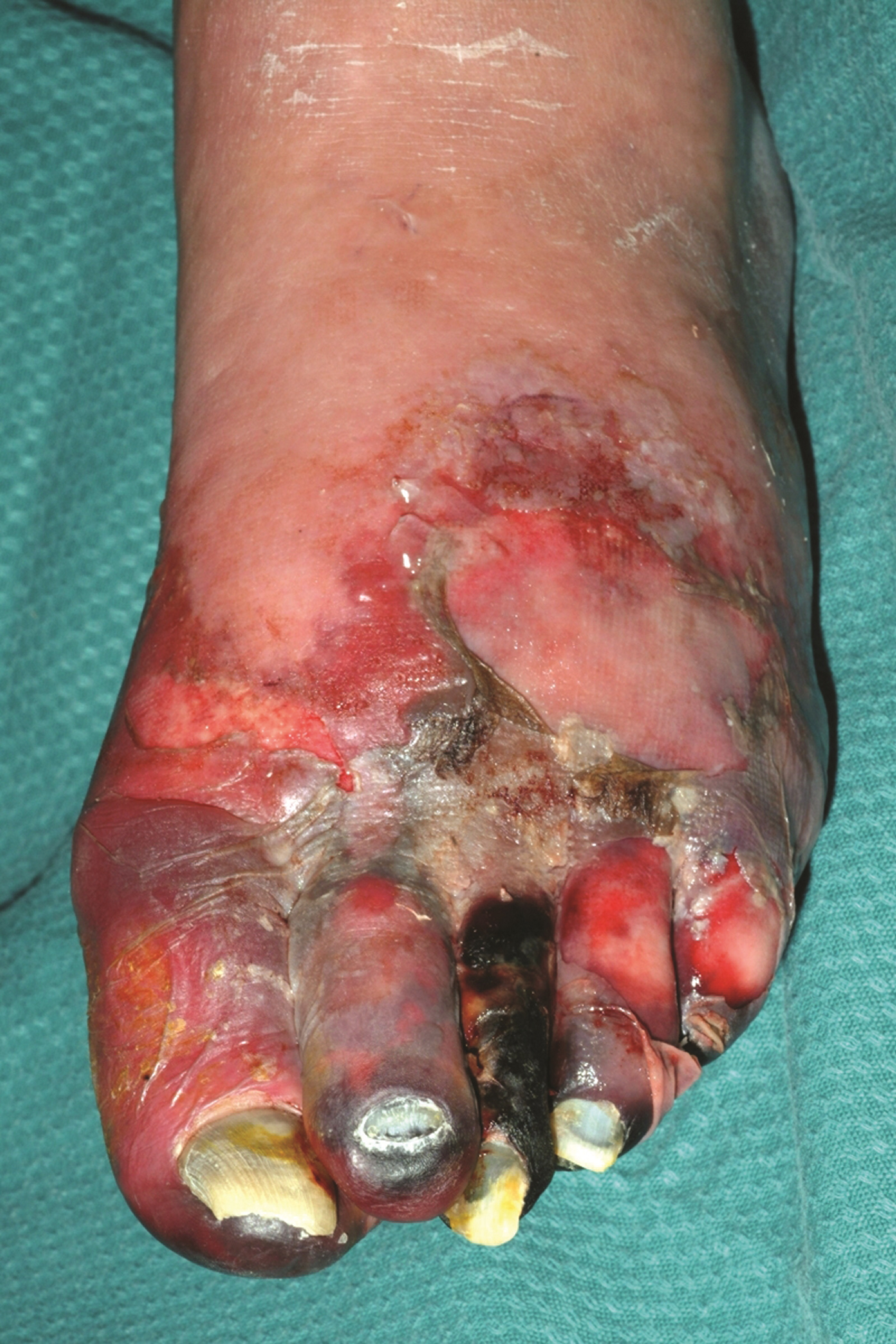 Smoking damages your blood vessels - New Zealand
