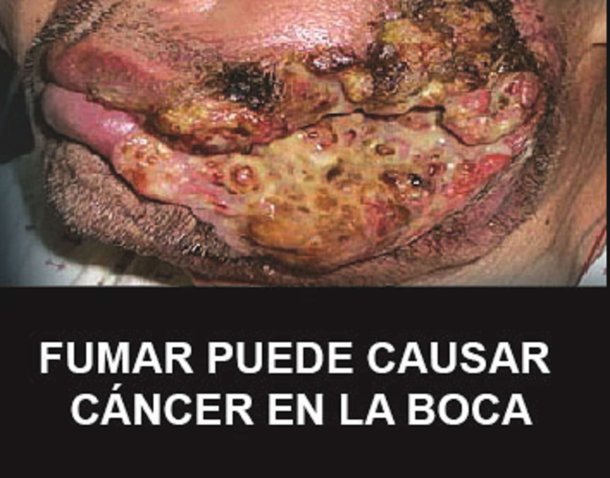 Smoking can cause cancers of the mouth