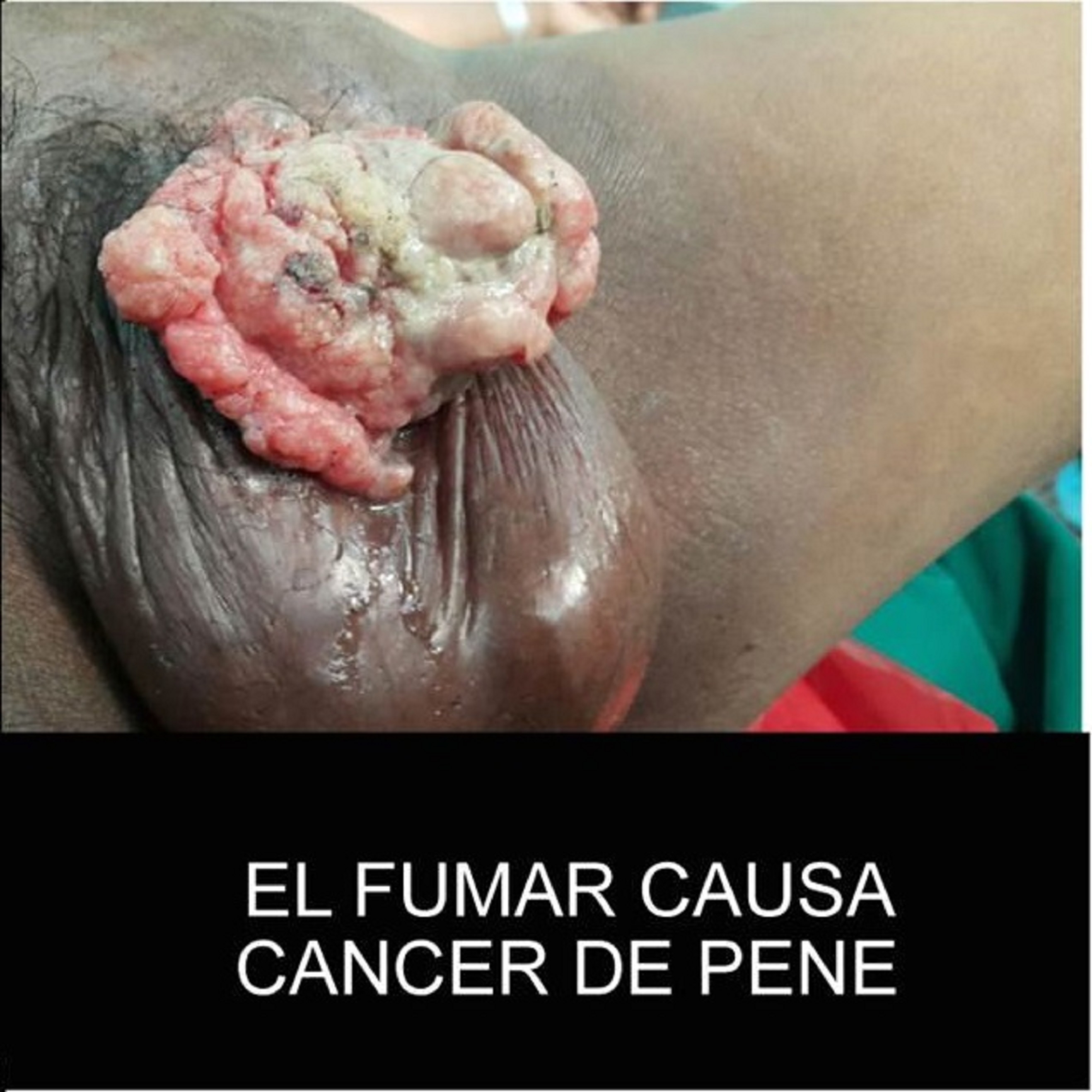 Smoking causes penis cancer