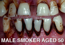 Smoking damages your gums and teeth - front of pack