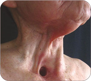 throat cancer from tobacco