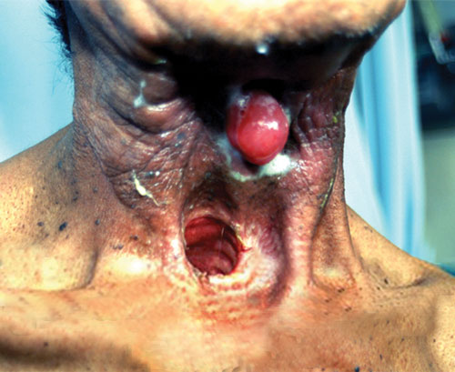 throat cancer from tobacco