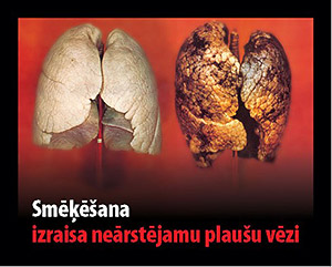 Smoking causes fatal lung cancer - Latvia