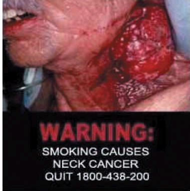 Smoking causes neck cancer - Image 1