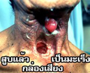 Smoking Causes Laryngeal Cancer - Image 1