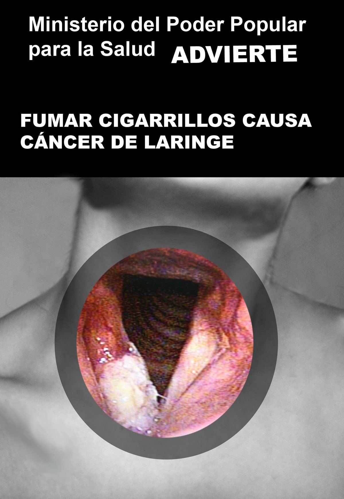 Smoking causes laryngeal cancer Venezuela image 2