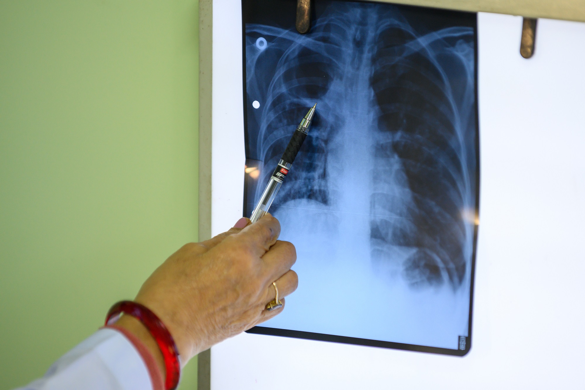 A healthcare worker observing the X-ray of a drug-resistant tuberculosis patient in Bagmati Province, Nepal