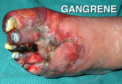 Smoking causes peripheral vascular disease - Australia