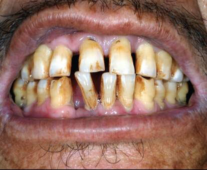 Effects Of Smoking Cigarettes On Teeth