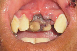 Smoking causes mouth cancer - Costa Rica