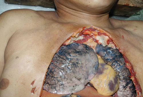 Smoking causes lung cancer and chronic bronchitis